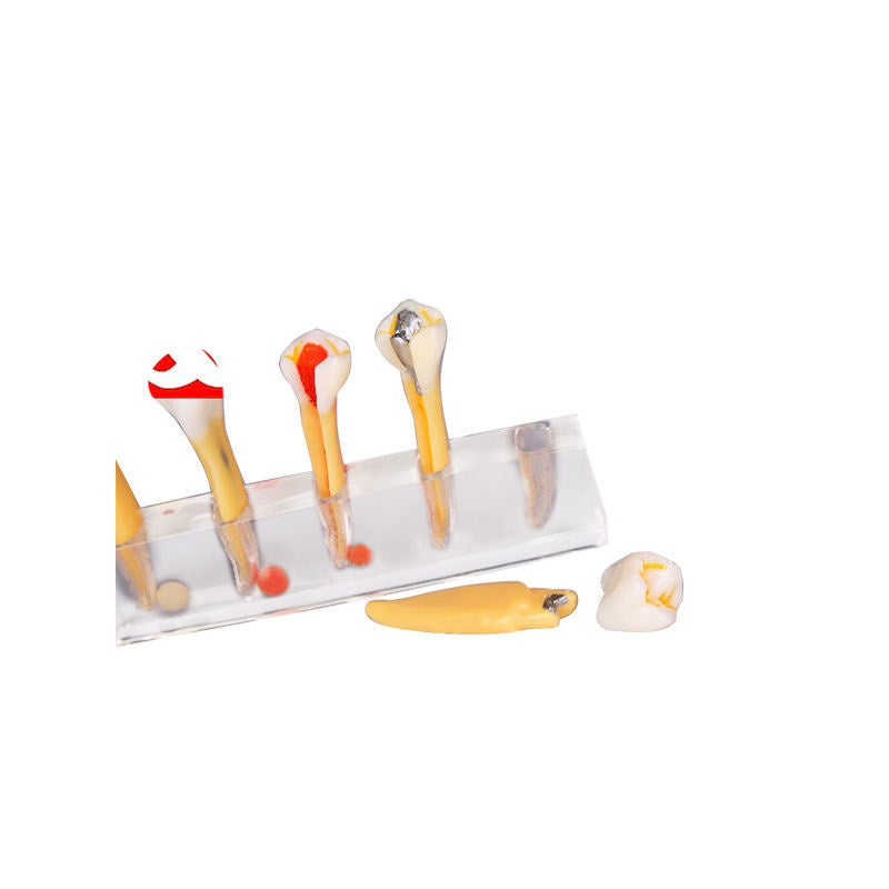 5 Stages Demonstration Model for Endodontic Treatment