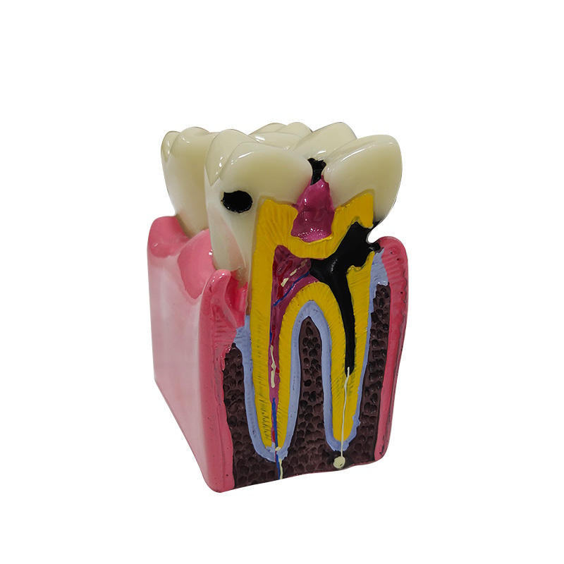 6 Times Caries Teeth Model for Two Side Anatomical Contrast Cross Section Bilateral Comparison