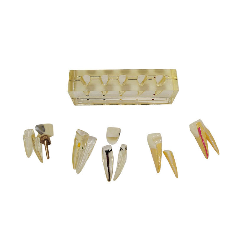 Teeth Pulp Disease Clinical Model for Dental Teaching Learning