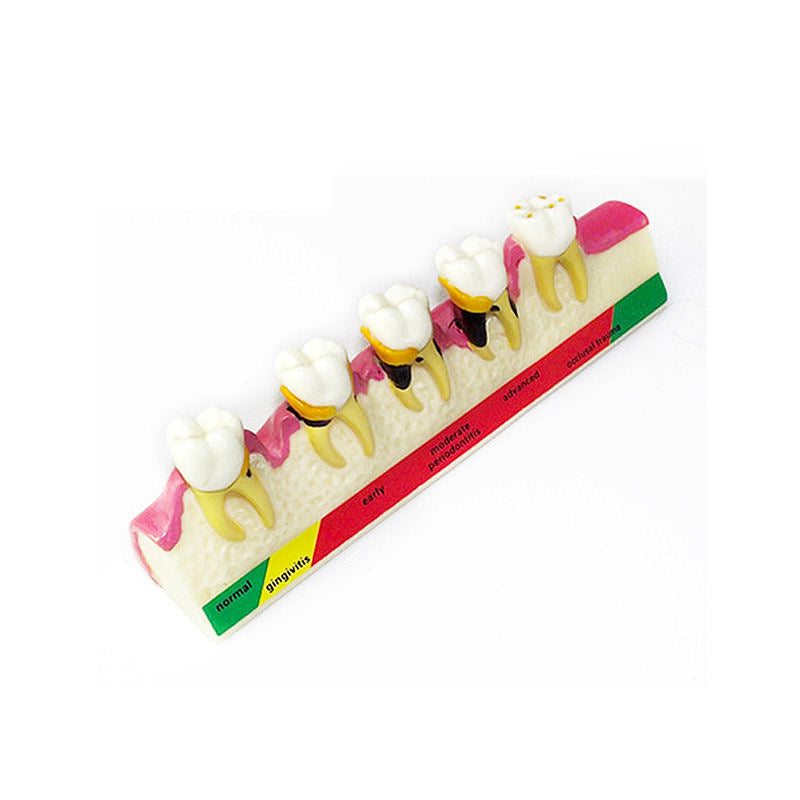 Dental Study Models Periodontal Disease Classification Model