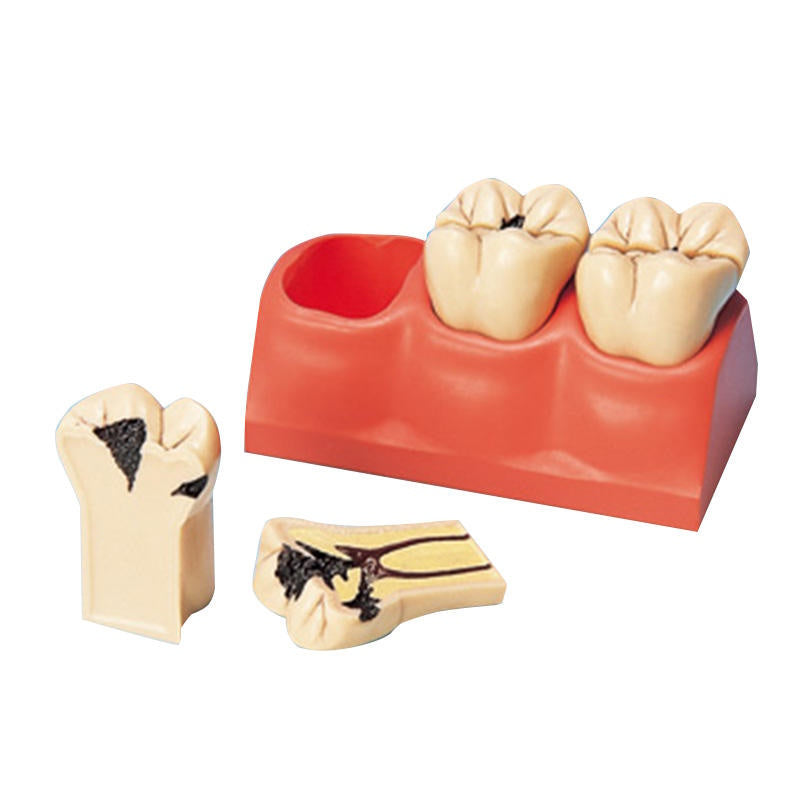 Medical Science Education Model 4 Times Sized Caries Disassembling Model