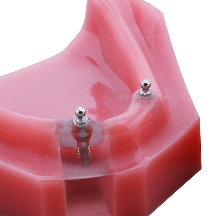 Overdenture 2 Implants Model With Restoration