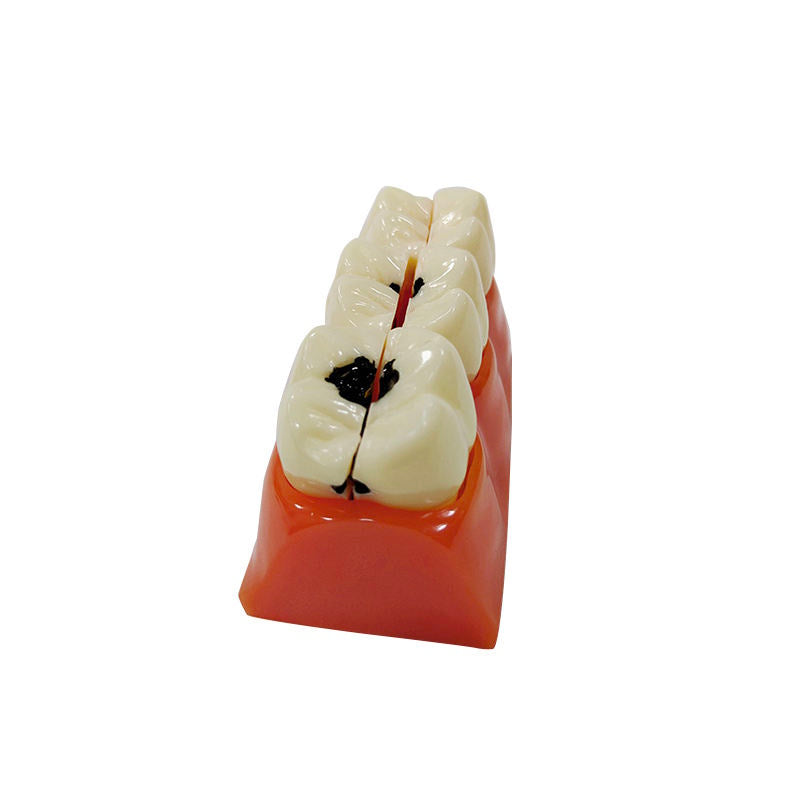 Medical Science Education Model 4 Times Sized Caries Disassembling Model