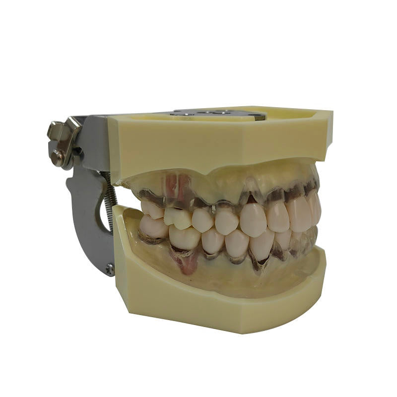 Periodontal Disease Model with Transparent Gum Demostrates Ginivae Recession