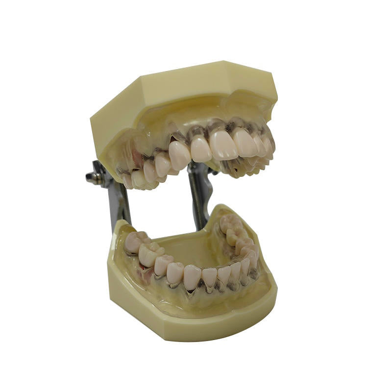 Periodontal Disease Model with Transparent Gum Demostrates Ginivae Recession