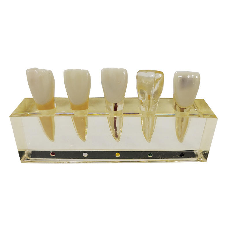 Teeth Pulp Disease Clinical Model for Dental Teaching Learning