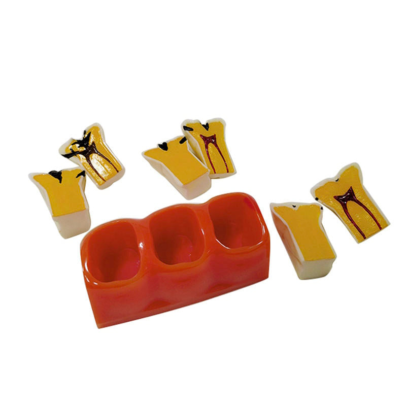 Medical Science Education Model 4 Times Sized Caries Disassembling Model