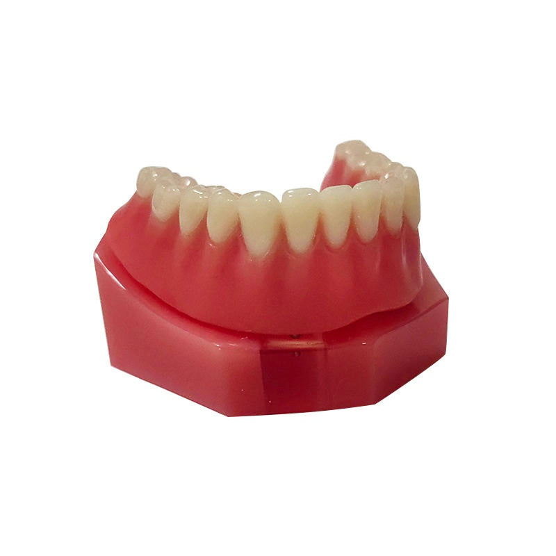 Overdenture 2 Implants Model With Restoration