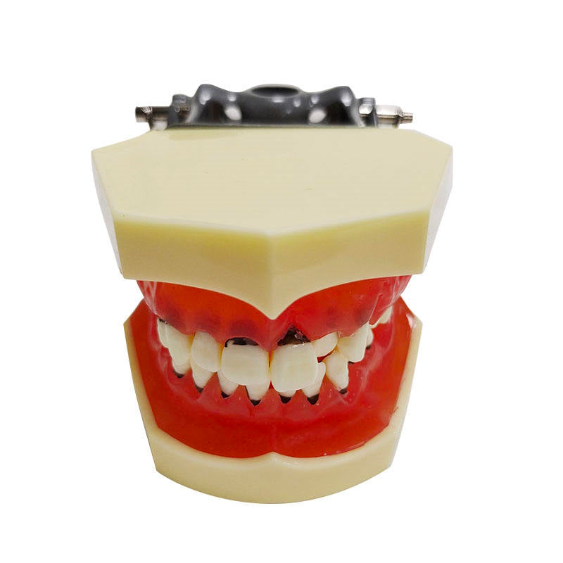 Hard Gingivae Periodontal Pathology Model with Calculus