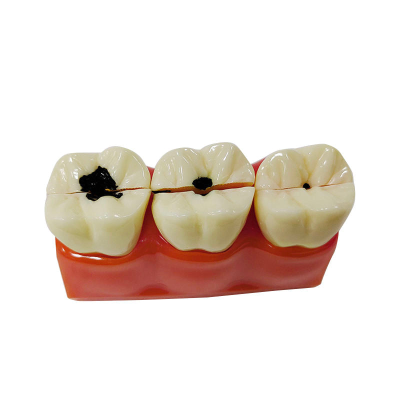 Medical Science Education Model 4 Times Sized Caries Disassembling Model