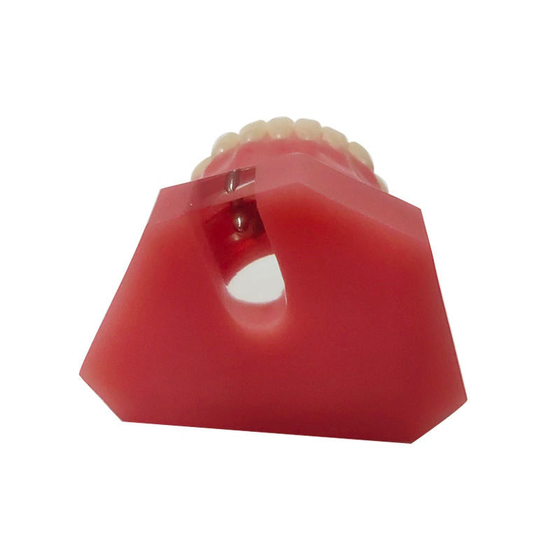 Overdenture 2 Implants Model With Restoration