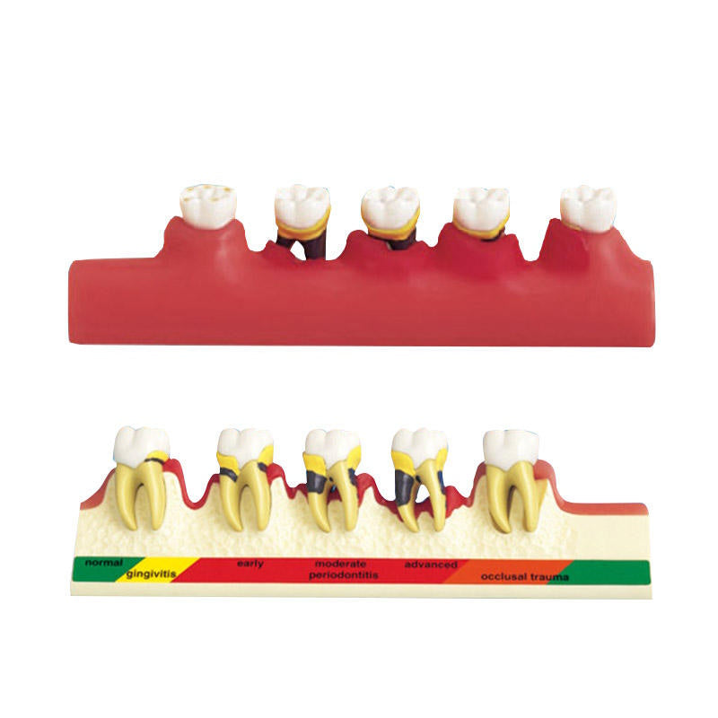 Dental Study Models Periodontal Disease Classification Model
