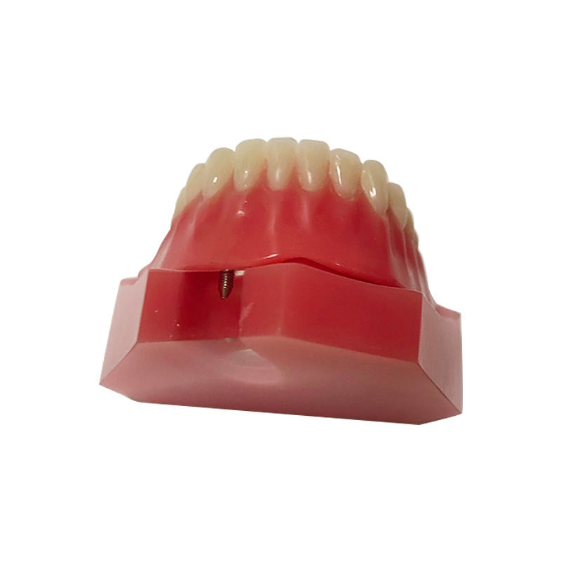 Overdenture 2 Implants Model With Restoration