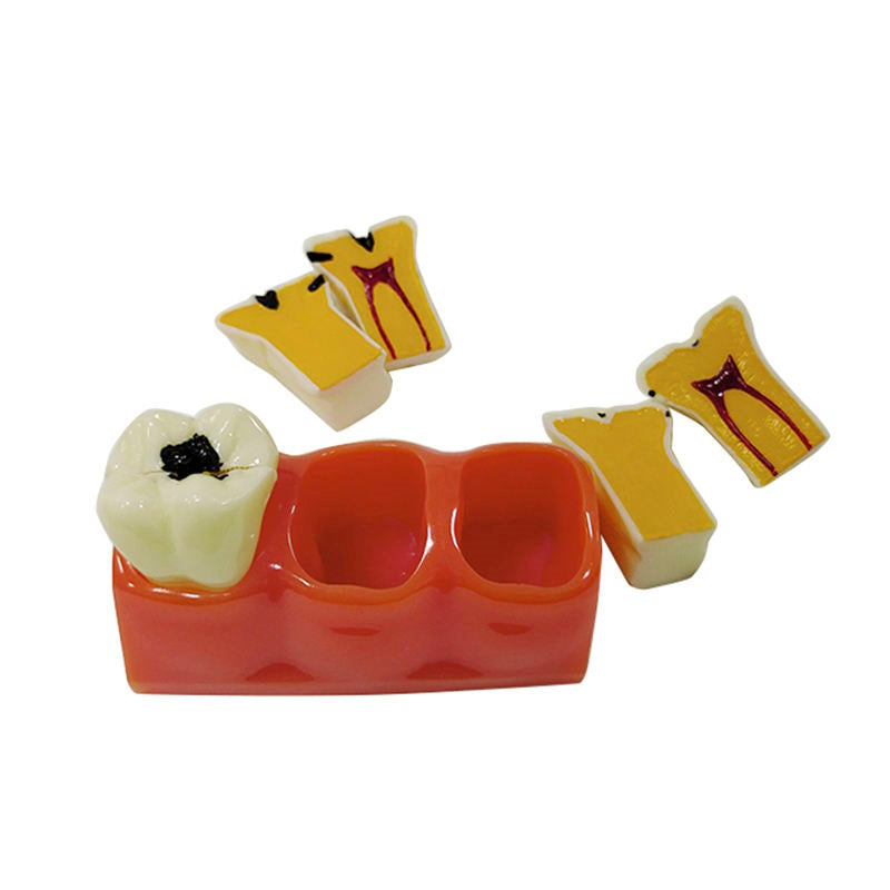 Medical Science Education Model 4 Times Sized Caries Disassembling Model