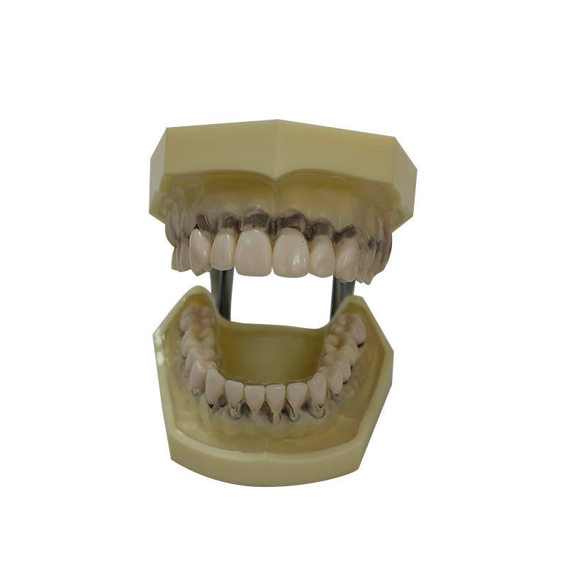 Periodontal Disease Model with Transparent Gum Demostrates Ginivae Recession
