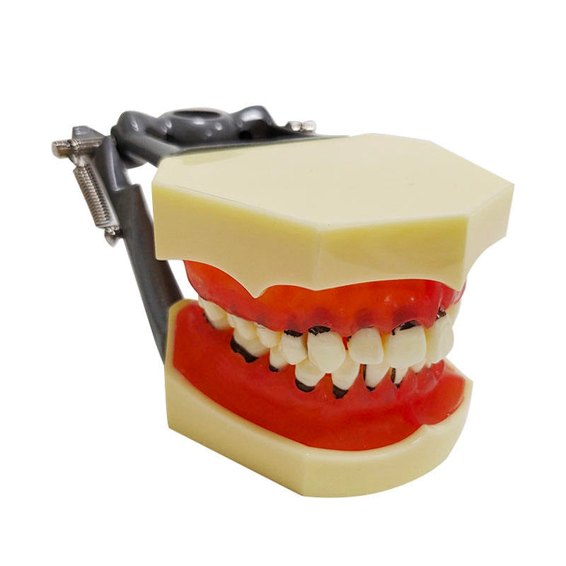 Hard Gingivae Periodontal Pathology Model with Calculus