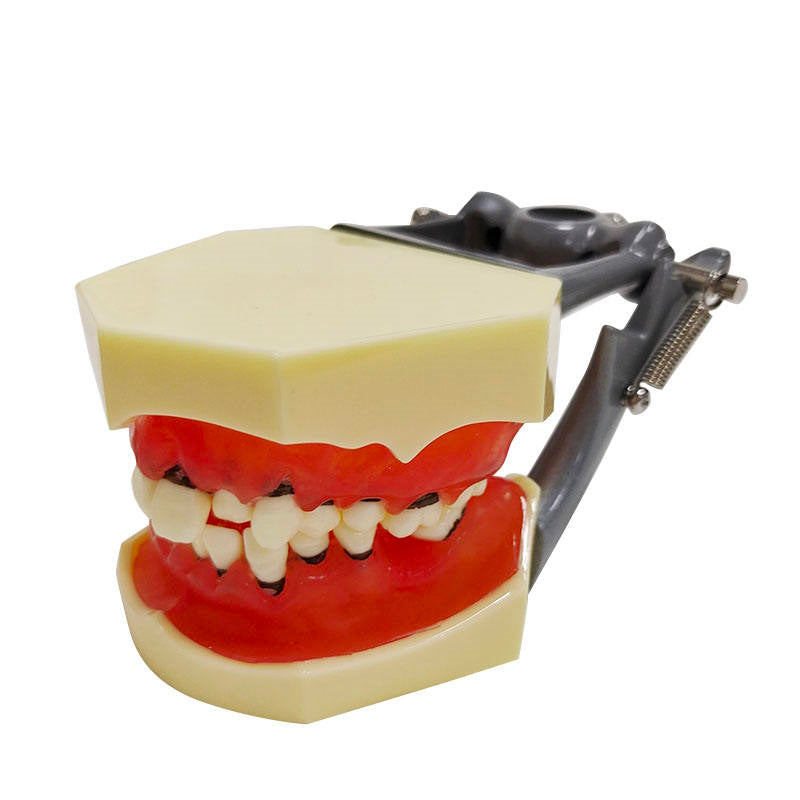 Hard Gingivae Periodontal Pathology Model with Calculus