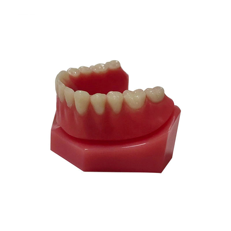 Overdenture 2 Implants Model With Restoration