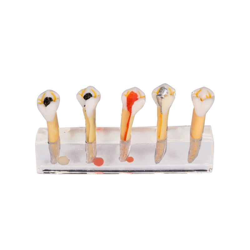 5 Stages Demonstration Model for Endodontic Treatment