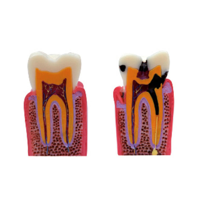 6 Times Caries Teeth Model for Two Side Anatomical Contrast Cross Section Bilateral Comparison